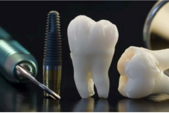 Імплантація